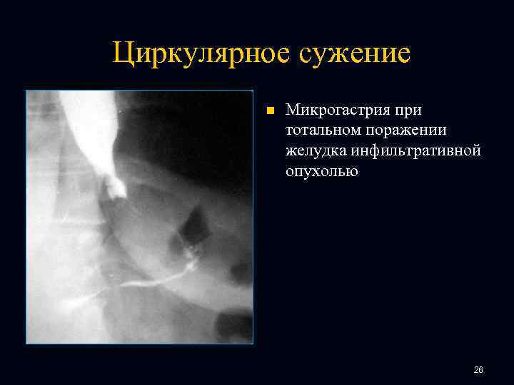 Циркулярное сужение n Микрогастрия при тотальном поражении желудка инфильтративной опухолью 26 
