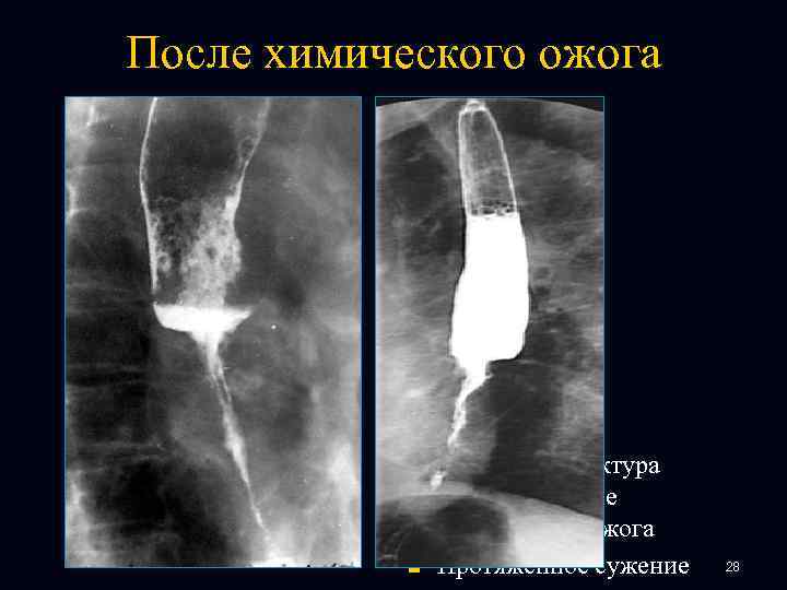 После химического ожога n n Рубцовая стриктура пищевода после химического ожога Протяженное сужение 28