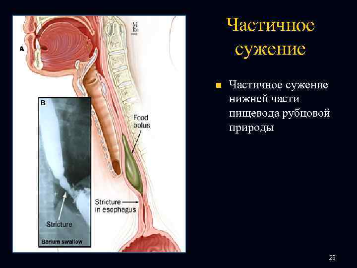Частичное сужение n Частичное сужение нижней части пищевода рубцовой природы 29 