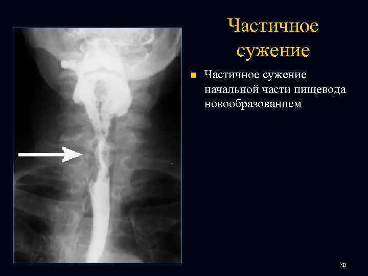 Частичное сужение n Частичное сужение начальной части пищевода новообразованием 30 