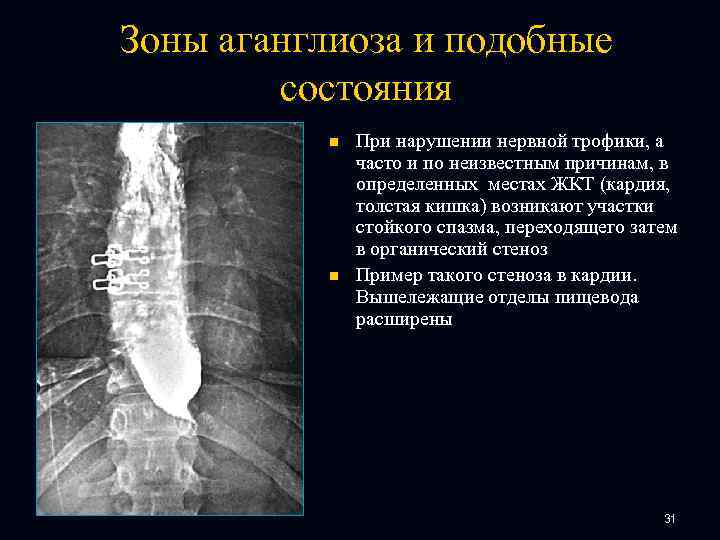 Зоны аганглиоза и подобные состояния n n При нарушении нервной трофики, а часто и