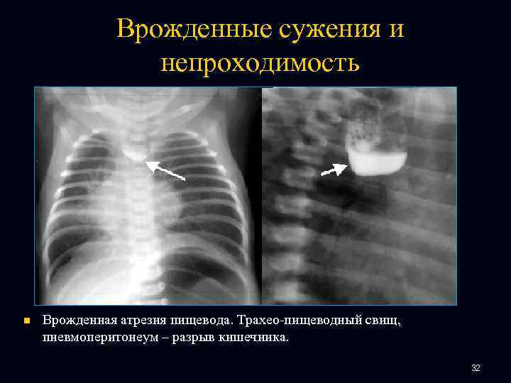 Врожденные сужения и непроходимость n Врожденная атрезия пищевода. Трахео-пищеводный свищ, пневмоперитонеум – разрыв кишечника.