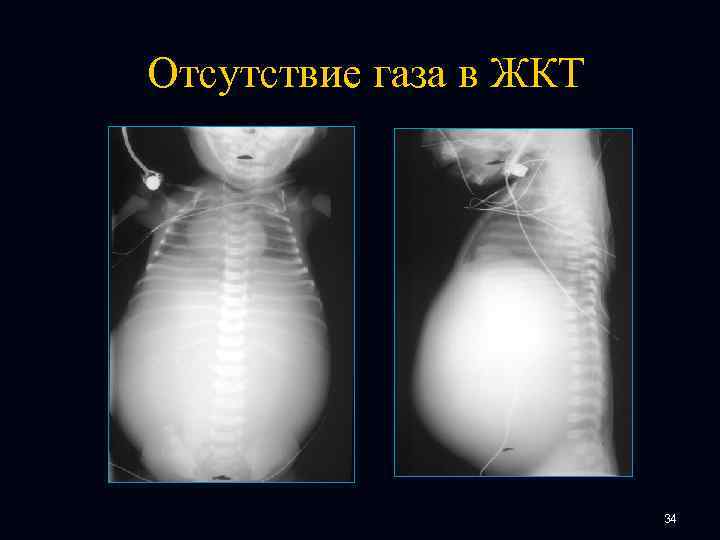 Отсутствие газа в ЖКТ 34 