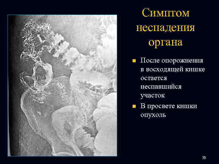 Симптом неспадения органа n n После опорожнения в восходящей кишке остается неспавшийся участок В