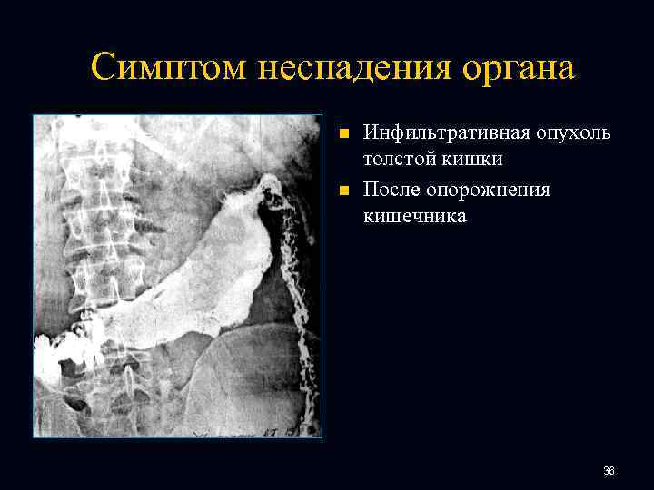 Симптом неспадения органа n n Инфильтративная опухоль толстой кишки После опорожнения кишечника 36 