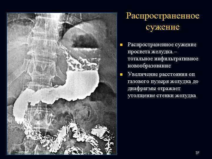 Распространенное сужение n n Распространенное сужение просвета желудка – тотальное инфильтративное новообразование Увеличение расстояния
