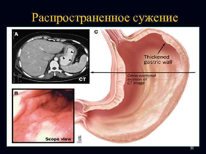 Распространенное сужение 38 