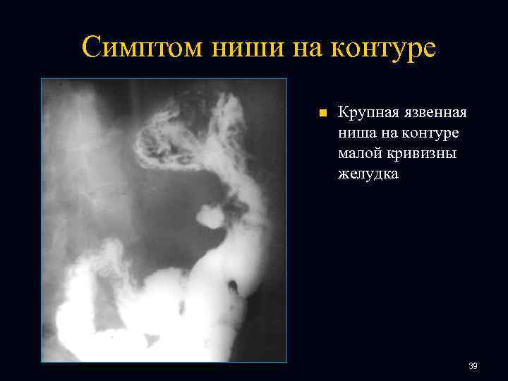 Симптом ниши на контуре n Крупная язвенная ниша на контуре малой кривизны желудка 39