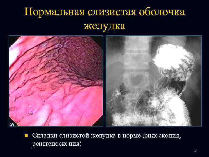 Нормальная слизистая оболочка желудка n Складки слизистой желудка в норме (эндоскопия, рентгеноскопия) 4 