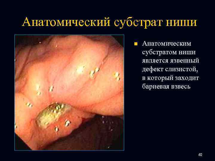 Анатомический субстрат ниши n Анатомическим субстратом ниши является язвенный дефект слизистой, в который заходит