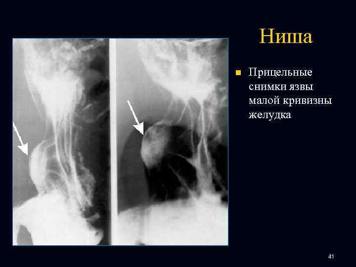 Ниша n Прицельные снимки язвы малой кривизны желудка 41 