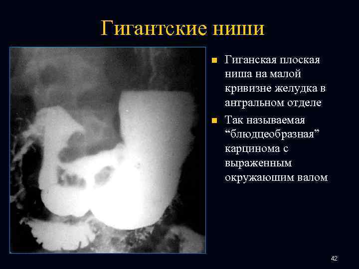 Гигантские ниши n n Гиганская плоская ниша на малой кривизне желудка в антральном отделе