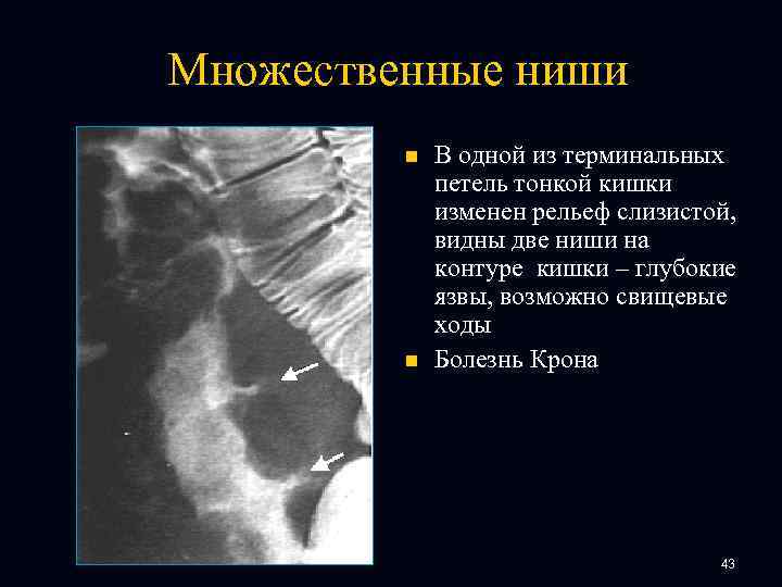 Множественные ниши n n В одной из терминальных петель тонкой кишки изменен рельеф слизистой,