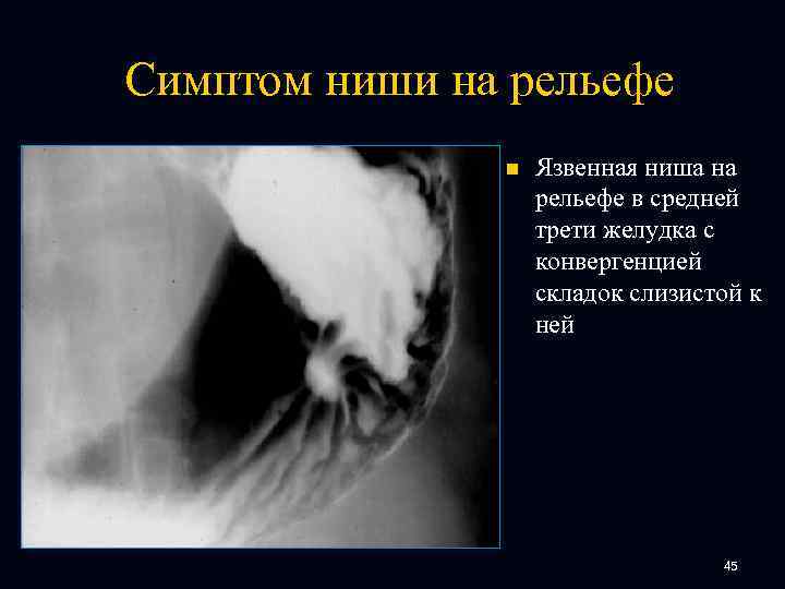 Симптом ниши на рельефе n Язвенная ниша на рельефе в средней трети желудка с