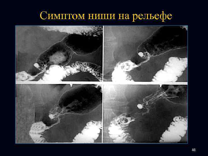 Симптом ниши на рельефе 46 