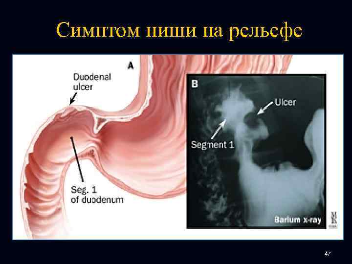 Симптом ниши на рельефе 47 