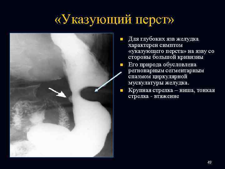  «Указующий перст» n n n Для глубоких язв желудка характерен симптом «указующего перста»