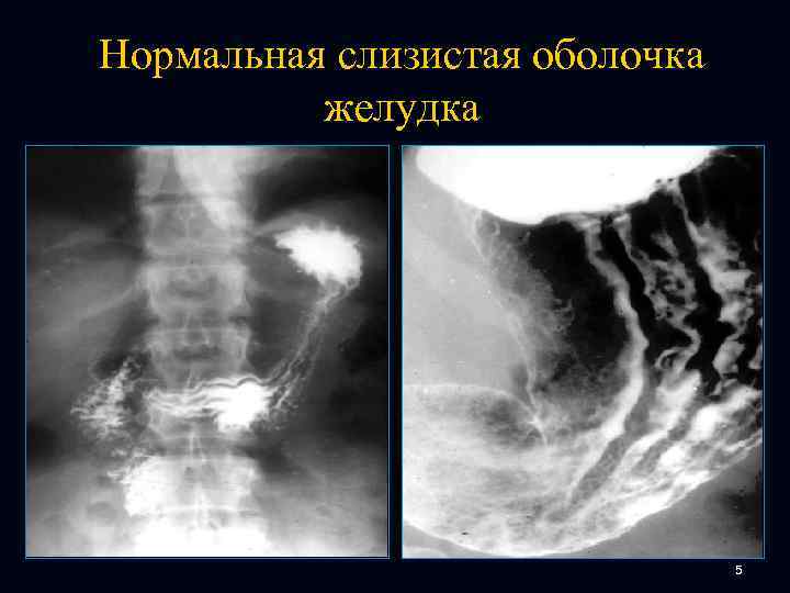 Нормальная слизистая оболочка желудка 5 