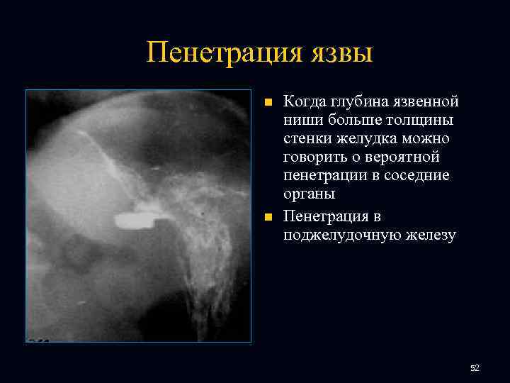 Пенетрация язвы n n Когда глубина язвенной ниши больше толщины стенки желудка можно говорить