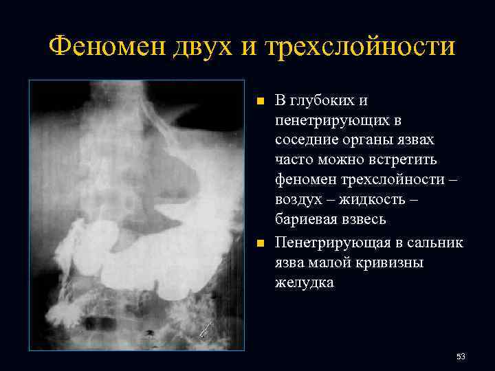 Феномен двух и трехслойности n n В глубоких и пенетрирующих в соседние органы язвах