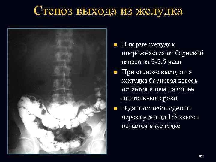 Стеноз выхода из желудка n n n В норме желудок опорожняется от бариевой взвеси