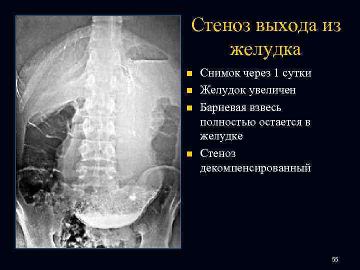 Стеноз выхода из желудка n n Снимок через 1 сутки Желудок увеличен Бариевая взвесь