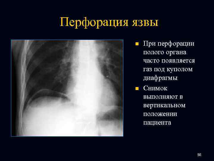 Перфорация язвы n n При перфорации полого органа часто появляется газ под куполом диафрагмы