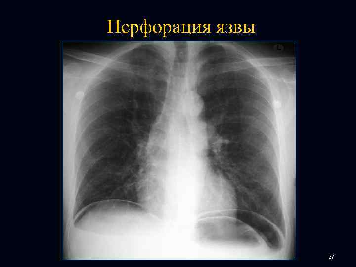 Перфорация язвы 57 