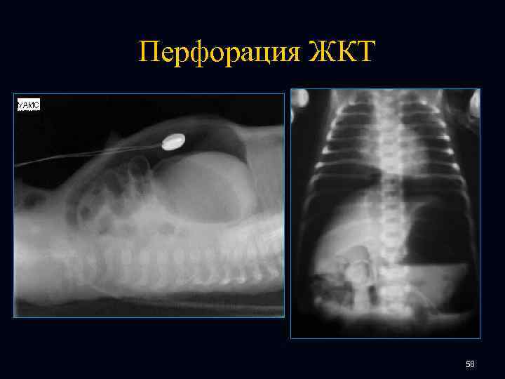 Перфорация ЖКТ 58 