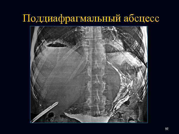 Поддиафрагмальный абсцесс 59 