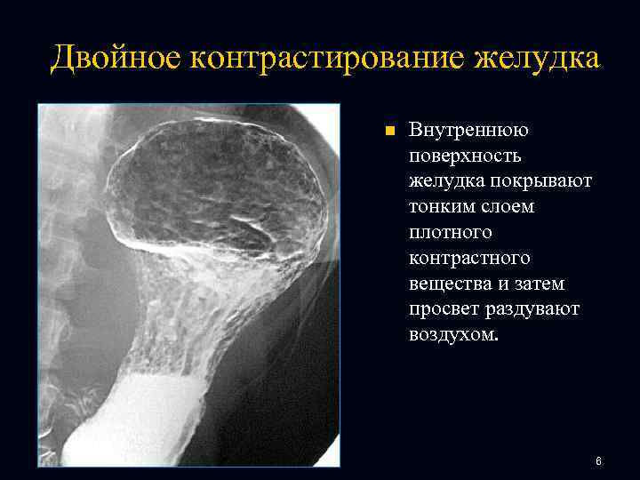 Двойное контрастирование желудка n Внутреннюю поверхность желудка покрывают тонким слоем плотного контрастного вещества и