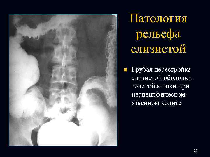 Патология рельефа слизистой n Грубая перестройка слизистой оболочки толстой кишки при неспецифическом язвенном колите