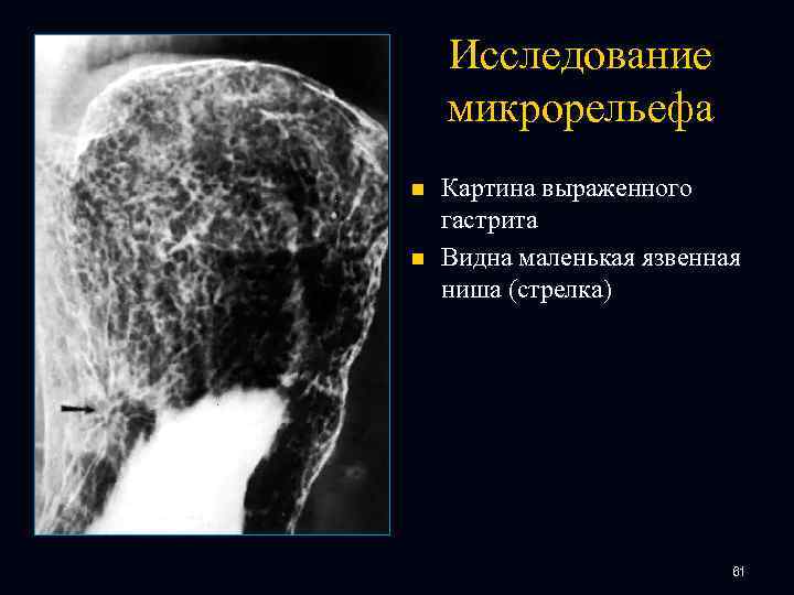 Исследование микрорельефа n n Картина выраженного гастрита Видна маленькая язвенная ниша (стрелка) 61 