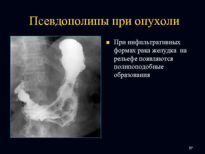 Псевдополипы при опухоли n При инфильтративных формах рака желудка на рельефе появляются полипоподобные образования