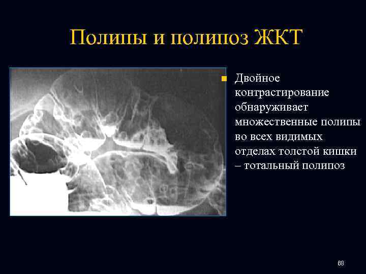 Полипы и полипоз ЖКТ n Двойное контрастирование обнаруживает множественные полипы во всех видимых отделах