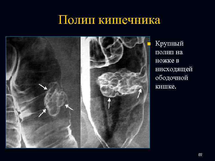 Полип кишечника n Крупный полип на ножке в нисходящей ободочной кишке. 69 