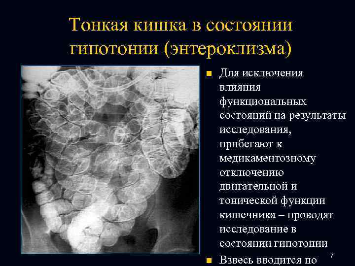 Тонкая кишка в состоянии гипотонии (энтероклизма) n n Для исключения влияния функциональных состояний на