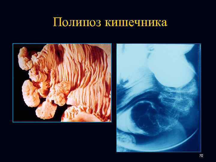 Полипоз кишечника 70 