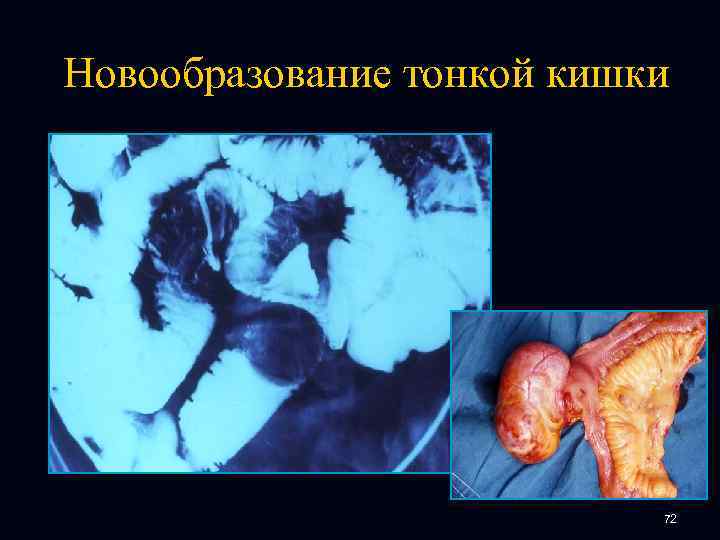 Новообразование тонкой кишки 72 