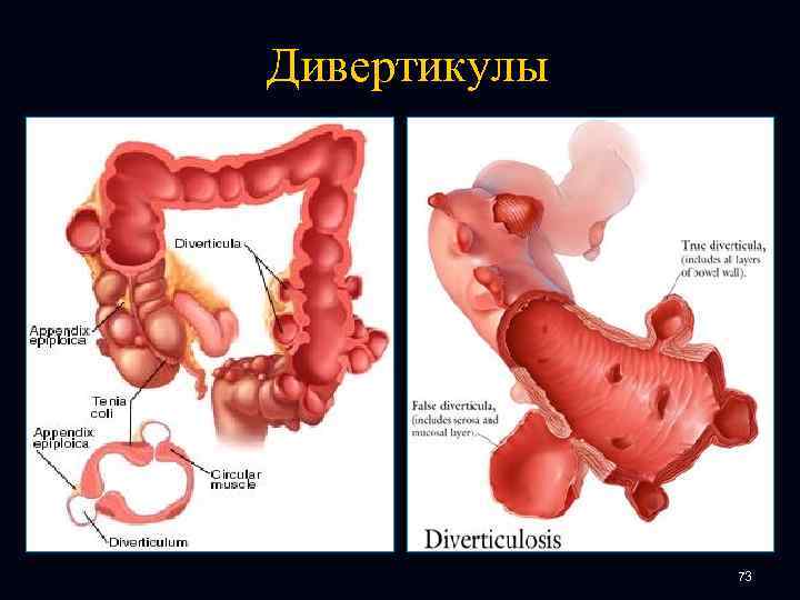 Дивертикулы 73 
