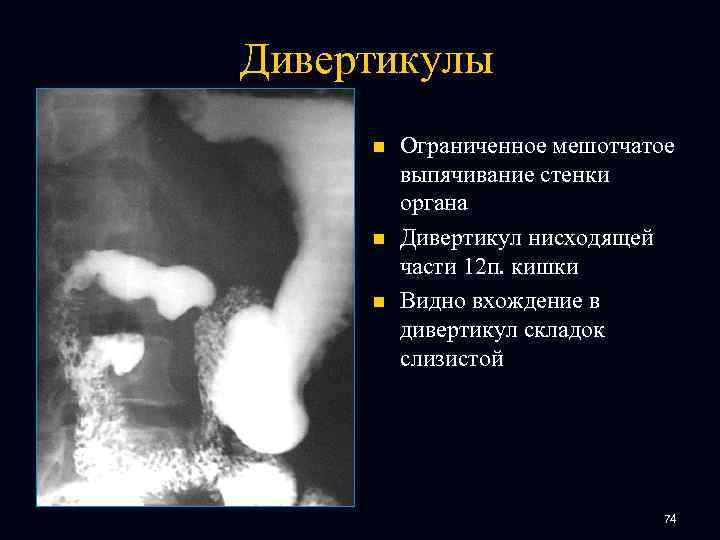 Дивертикулы n n n Ограниченное мешотчатое выпячивание стенки органа Дивертикул нисходящей части 12 п.