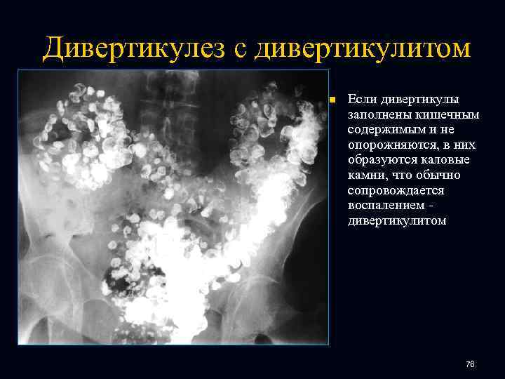 Дивертикулез с дивертикулитом n Если дивертикулы заполнены кишечным содержимым и не опорожняются, в них