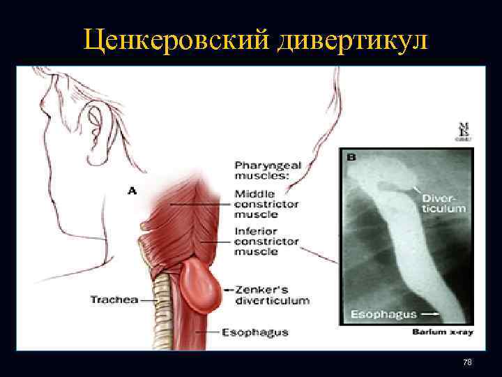 Ценкеровский дивертикул 78 
