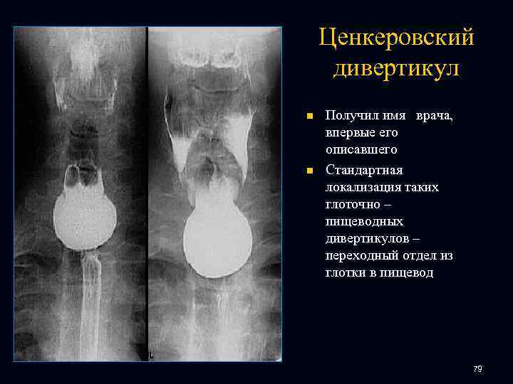 Ценкеровский дивертикул n n Получил имя врача, впервые его описавшего Стандартная локализация таких глоточно