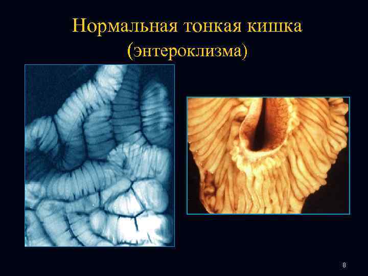 Нормальная тонкая кишка (энтероклизма) 8 