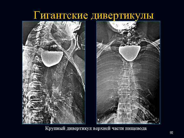 Гигантские дивертикулы Крупный дивертикул верхней части пищевода 80 