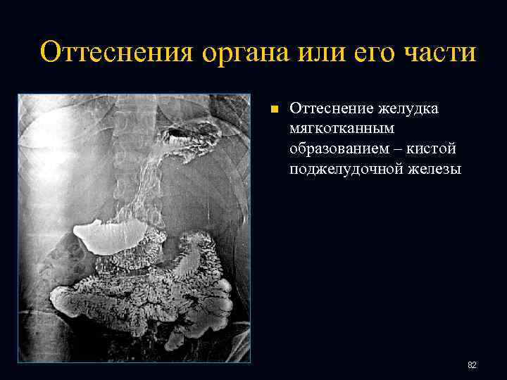 Оттеснения органа или его части n Оттеснение желудка мягкотканным образованием – кистой поджелудочной железы