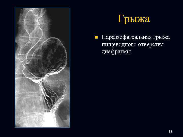 Грыжа n Параэзофагеальная грыжа пищеводного отверстия диафрагмы 83 