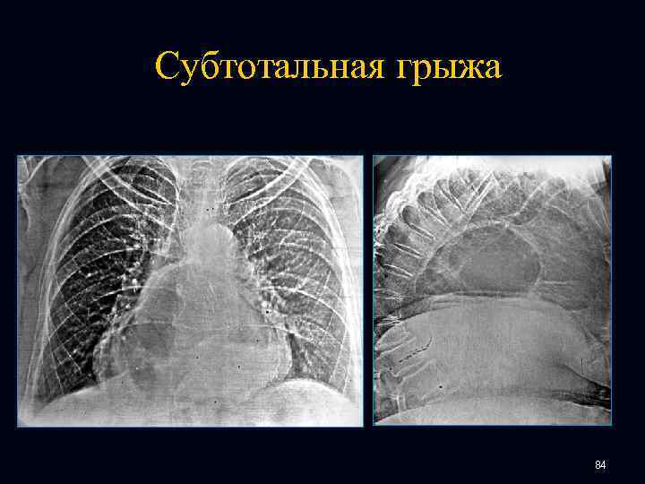 Субтотальная грыжа 84 