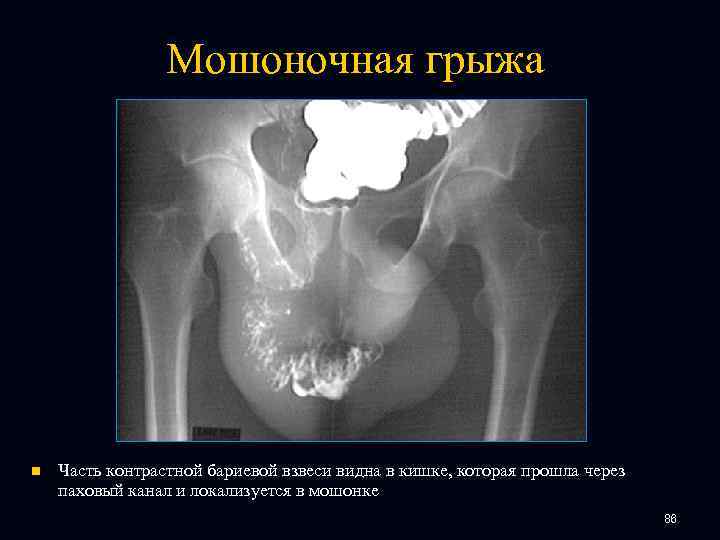Мошоночная грыжа n Часть контрастной бариевой взвеси видна в кишке, которая прошла через паховый